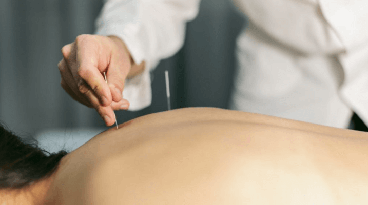 Acupuncture Services for Natural Healing and Wellness