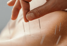 Acupuncture Services for Holistic Healing and Pain Relief