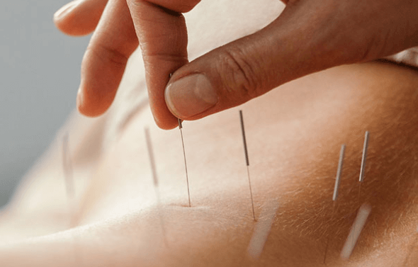 Acupuncture Services for Holistic Healing and Pain Relief